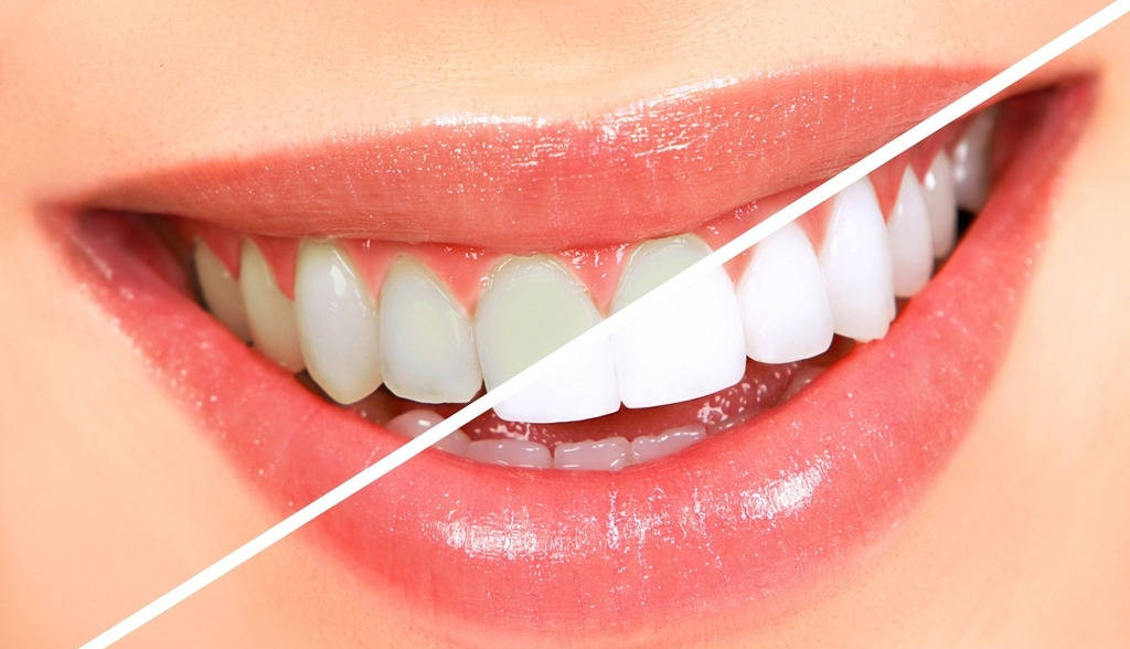 美白牙齿的牙膏怎么选？