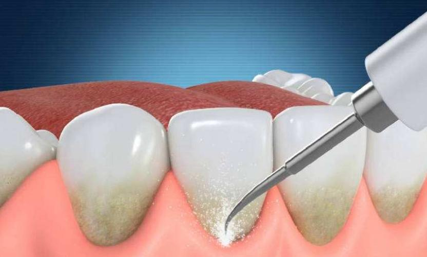 人工种植牙的优点有哪些？