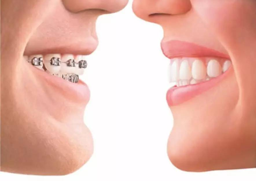 矫正牙齿所使用的金属自锁和非自锁的区别有哪些？