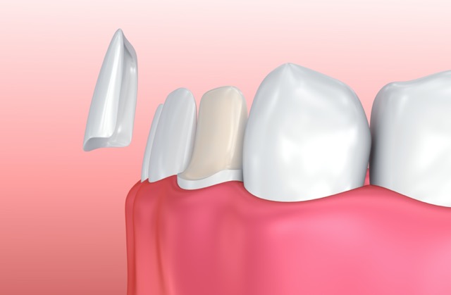 瓷贴面牙齿美白能保持多久